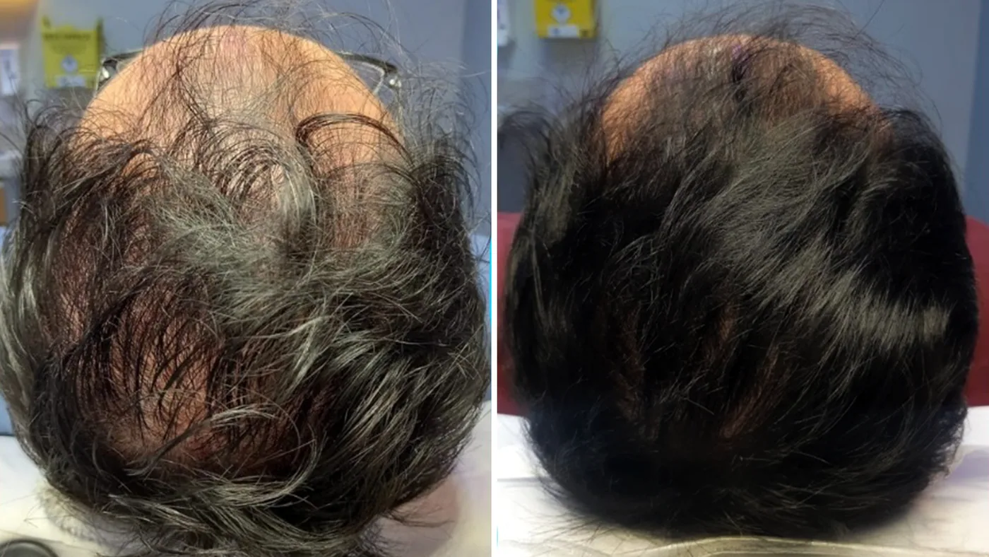 Antes e depois do tratamento capilar de um paciente da Homenz São Carlos