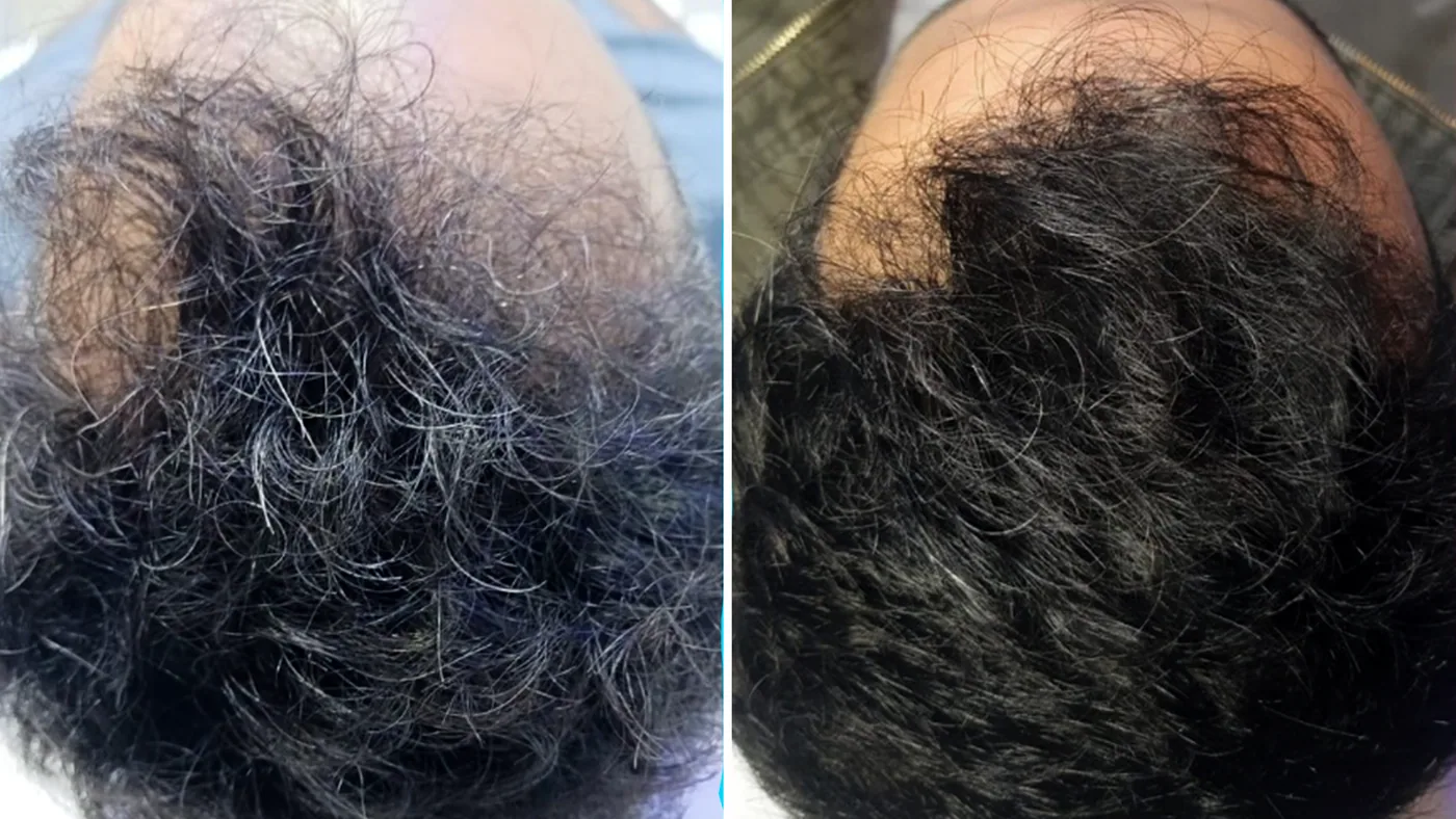 Antes e depois do tratamento capilar de um paciente da Homenz São Carlos
