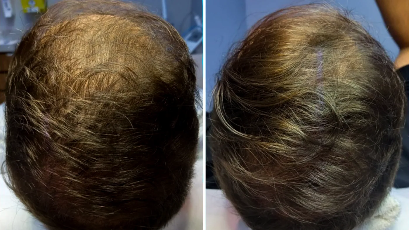 Antes e depois do tratamento capilar de um paciente da Homenz São Carlos