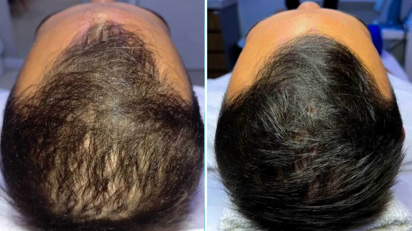 Antes e depois do tratamento capilar de um paciente da Homenz São Carlos