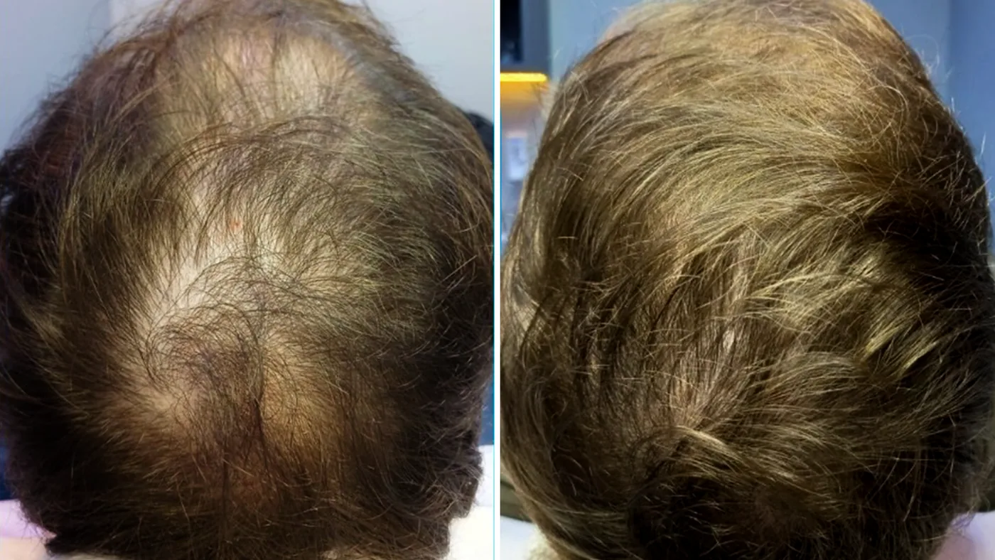 Antes e depois do tratamento capilar de um paciente da Homenz São Carlos
