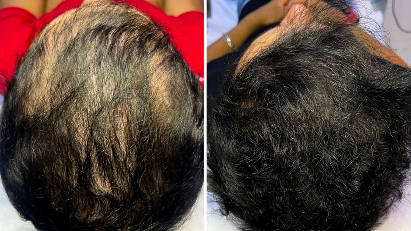 Antes e depois do tratamento capilar de um paciente da Homenz São Carlos